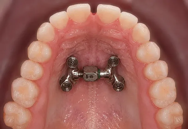 Darstellung eines Oberkiefers mit Miniimplantat-gestützter Oberkiefererweiterung (MARPE)