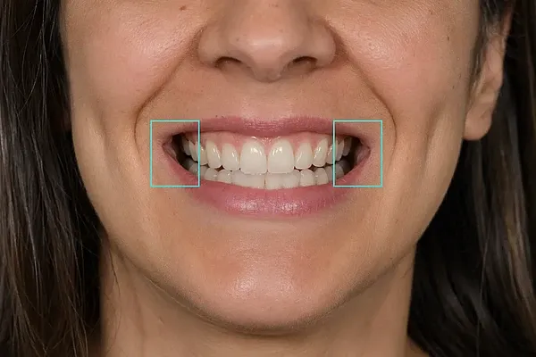 Mund mit sichtbaren Buccal Corridors – dunkle Bereiche zwischen den Seitenzähnen und den Mundwinkeln.
