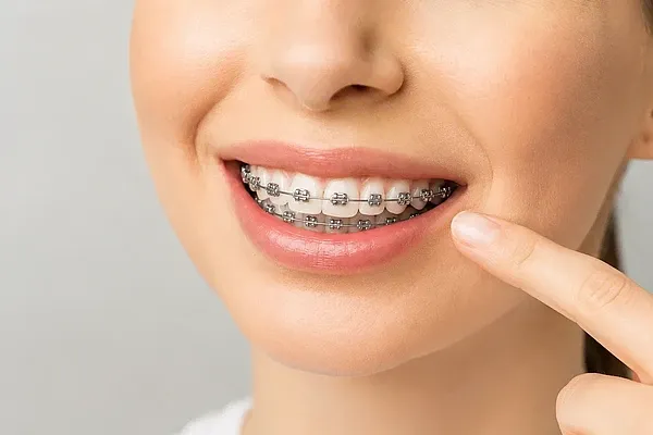 Feste Zahnspange mit Metallbrackets auf den Zähnen während einer kieferorthopädischen Behandlung
