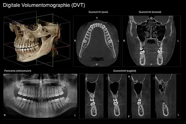 Digitale Volumentomographie (DVT) auf einem Bildschirm