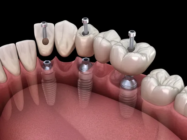3D illustration, ceramic, artificial, crown, dent, dental, dentist, dentistry, denture, human, illustration, implant, implantat, implantation, implanted, install, installation, jaw, molar, prosthesis, prosthetic, recovery, root, smile, gingiva, surgery, teeth, tooth, transparent, treatment, orthodontic, gum, premolar, titanium, installed, abutment, render, bridge, missing, restoration, console, Animation