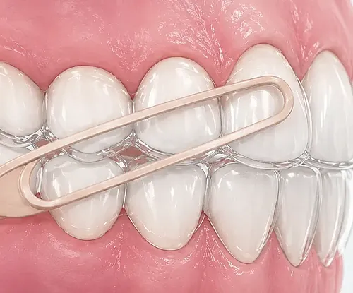 3D-Darstellung von Invisalign-Alignern mit Gümmizügen zur präzisen Zahnbewegung während einer transparenten Aligner-Behandlung.