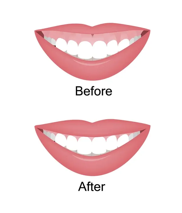 Vorher Nachher Gummy Smile München Zahnfleischlächeln München Zahnfleischüberschuss